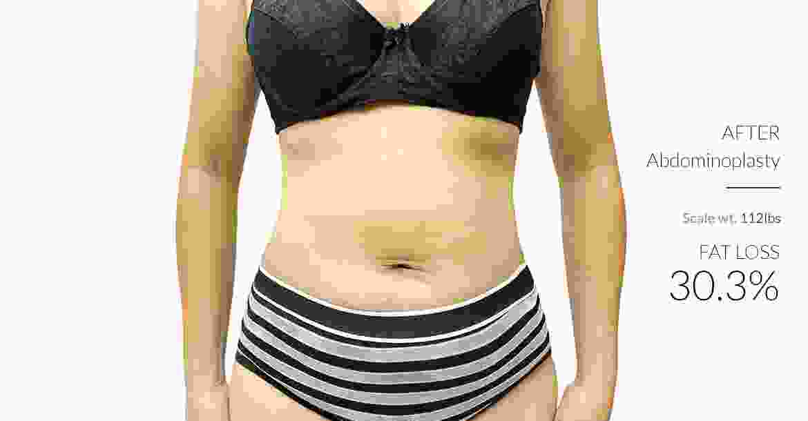 After-Abdominoplasty