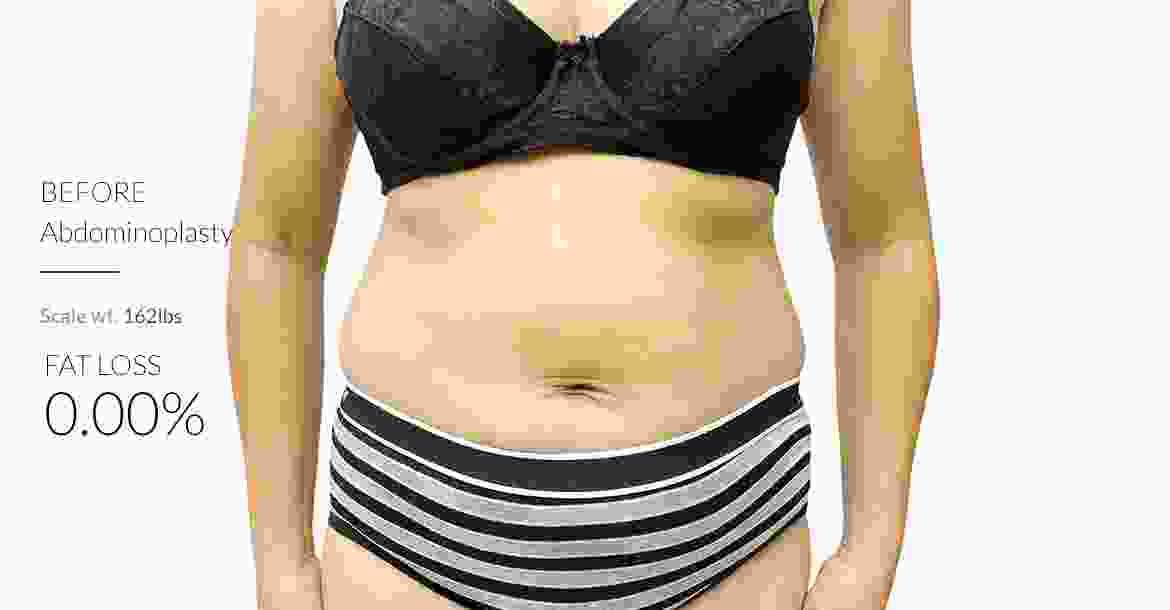 Before-Abdominoplasty